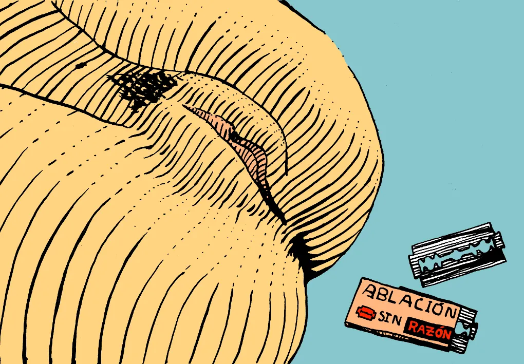 Ilustración estilizada en amarillo sobre fondo turquesa con dos hojas de afeitar y la etiqueta «Ablación sin razón»